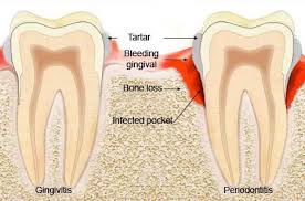 Image result for Gingivitis
