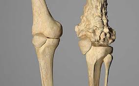 Image result for Osteosarcoma
