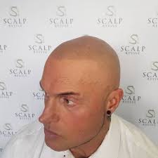 14 hair loss treatments and remedies. Scalp Micropigmentation Gallery Hair Tattoo Uk Leeds Scalp Revive