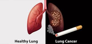 The 10 warning signs of lung cancer. Lung Cancer