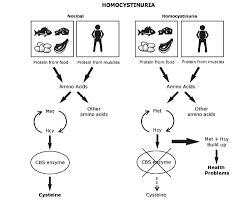 Image result for Homocystinuria