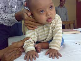 Heart Diseases In Down Syndrome Intechopen