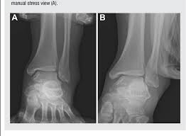 Image result for Ankle External Rotation Test