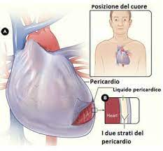 La pericardite nella sindrome di dressler può complicare l'infarto e insorge tra la seconda e la terza settimana dopo la fase acuta. Pericardite