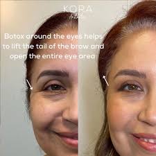 Botox Injections Near Me in Scottsdale, AZ