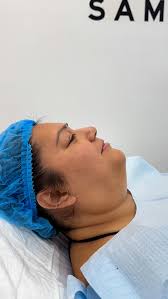 Increible resultado SELFIE PACKAGE con neck lift cerrado con suturas de PDO