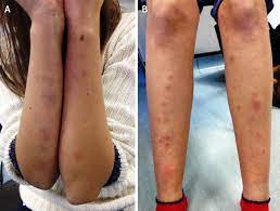 Rash On The Arms And Legs The Bmj