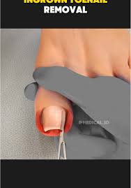 Image result for Toenail Removal