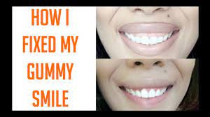 How to get rid of gummy smile naturally. How I Fixed My Gummy Smile Whitening Kit Youtube