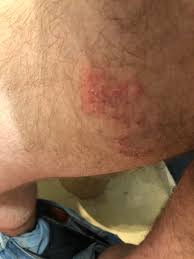 Any inner thigh pain can be alleviated by experimenting with various household or natural remedies. Large Rash With Puss Bubbles On Inner Thigh Close To Penis Medical Advice