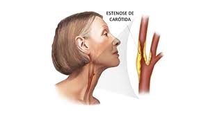O manejo da estenose da bifurcação carotídea visa principalmente a prevenir o acidente vascular cerebral e tem sido objeto de extensa investigação. Doenca Carotidea Ou Estenose Da Arteria Carotida