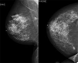 The idea of the screening programme is to use the usually if the mammogram finds a problem on screening, you will be sent an appointment with a specialist breast clinic. Breast Cancer Screening Radiology Key