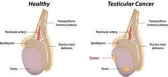 Your treatment will depend on several things including your diagnosis, your overall. Testicular Cancer Classification