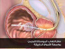 علاج التهاب البروستاتا المزمن نهائيا في تركيا - بيمارستان
