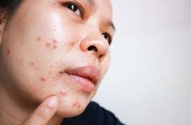 Best Acne Treatment in Acworth