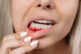 Image result for Post-Tooth Extraction Bleeding