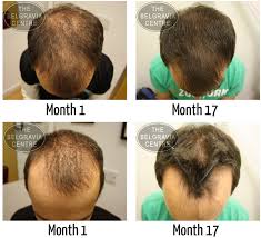 Clinical studies have indeed shown that rogaine can effectively regrow hair in some people. Guide To Different Levels Of Hair Regrowth From Treatment