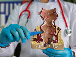 Image result for Proctitis