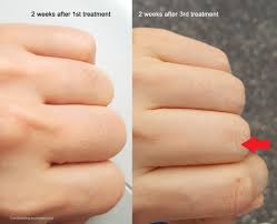 Tria laser hair removal side effects. Tria Hair Removal 4x Worth It Chic Dabbling