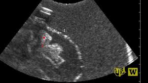 Trial To Test Using Ultrasound To Move Kidney Stones Uw News Average imaging costs were about 33% to 50% higher for ct (average, $300) than for ultrasound ($150 if done by an emergency physician, and $200 if this study shows that emergency department physicians need not fear missing a diagnosis of kidney stones or other causes of acute pain if they. using ultrasound to move kidney stones