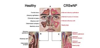 Nasal polyps (np) are noncancerous growths within the nose or sinuses. Can Nasal Polyps Cause Cancer