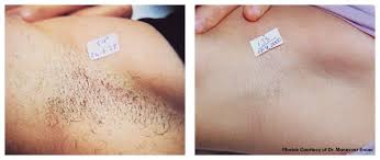 Wash the targeted area with warm water and pat dry with a towel. Hair Removal Of The Arm Pits Photo Courtesy Of Candela Alexalexa Medispa Wv Hairremoval Dark Armpits Hair Removal Cream Hair Removal