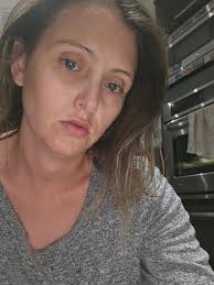 Those with Hashimoto's Disease did your symptoms reverse after getting  explant surgery? I was just diagnosed & believe the implants caused this  disease 😬