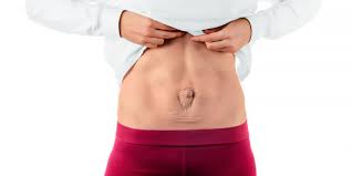 Diastase Abdominal Afeta Tanto A Mulheres Como A Homens 2022