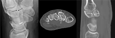 Image result for Trapezoid Bone