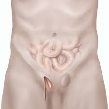 An inguinal hernia occurs when part of the sac that lines the abdomen pushes through a weak spot in the inguinal canal (an opening between layers of abdominal muscle near the groin between the. Open Inguinal Hernia Repair Male Healthdirect