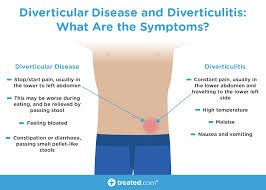 Diverticular Disease And Diverticulitis Are They Related To Ibs