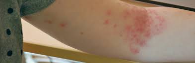 Find out what the symptoms are, how it's spread and how it's treated. Mooci Hautausschlag Das Sind Mogliche Ursachen