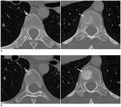This can allow for examination of neighboring organs and structures like lymph nodes to check for any signs of disease. Patient With Breast Cancer And Bone Metastasis A Ct Scans At Baseline Download Scientific Diagram