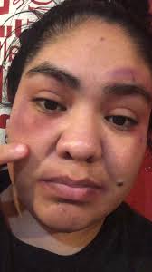 MIREN COMO TENGO MI CARA😭😰🥺#megolpee #lastimadura #hazmeviral #para...