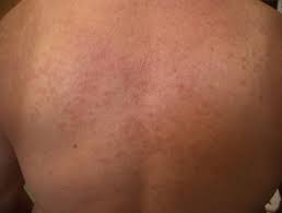 Darunter verstehen mediziner helle hautflecken von der größe einer münze, typisch ist eine feine, kleieförmige schuppung. Definiciones Dermatologia Archives Seite 38 Von 233 Dermatly Com El Sitio De Tu Piel