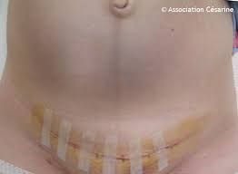 Séance unique avec les seules cymbales tibétaines. Cesarine Photo De Cicatrice