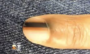 If you have a client who has black lines in their nail bed, it may be a cause for concern. Here S Why You Should See A Doctor If You Notice Black On Your Nail