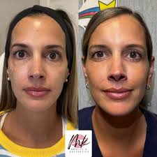 Healed lips from a year ago that I did and a little refresh today with  @revanesseusa Versa Lips💋 She is such a stunner! Come get your perfect  pout by me. #revanessereveal #xeomin #