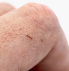 How to draw a splinter out naturally? How To Remove A Splinter Methods And Tips