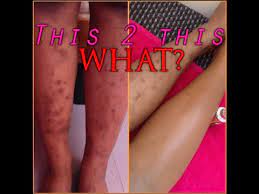 In this article, we look at popular ways to get rid of leg scars. Scarred Legs Fear No More Tutorial Youtube