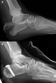 Image result for Calcaneus Compression Fracture