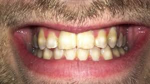 I've been smoking for about a month, i don't smoke very often maybe one every two days if you average it out? Is Smoking With Braces Really Unhealthy 2020 Checklist
