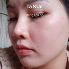 Sờ thấy silicone ở chóp mũi liệu có bình thường không?