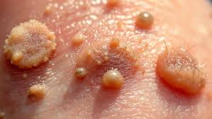Image result for genital warts