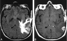 Image result for Brain Lesion
