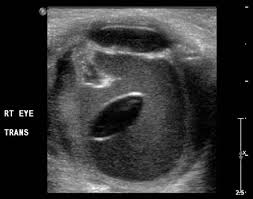 Image result for Lens Dislocation