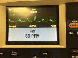 Image result for Transcutaneous Pacing