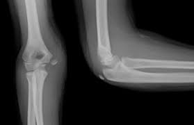 This area can become tender to the touch. Clinical Practice Guidelines Medial Epicondyle Fracture Of The Humerus Emergency Department