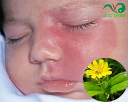 Hướng dẫn cách dùng cây sài đất trị chàm sữa