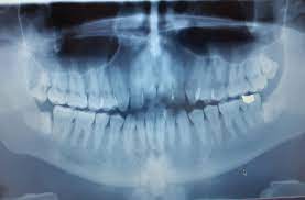 Make sure you finish any course of antibiotics you've been given. Impacted Lower Wisdom Teeth Pretty Painful Recently Infected On The Right Between The Molar And Wisdom Tooth Medizzy